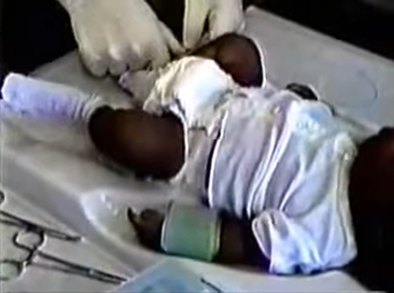 Gomco Circumcision Clamp