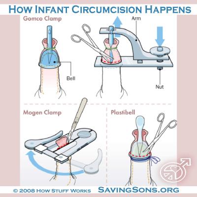Circumcision Clamp Diagrams